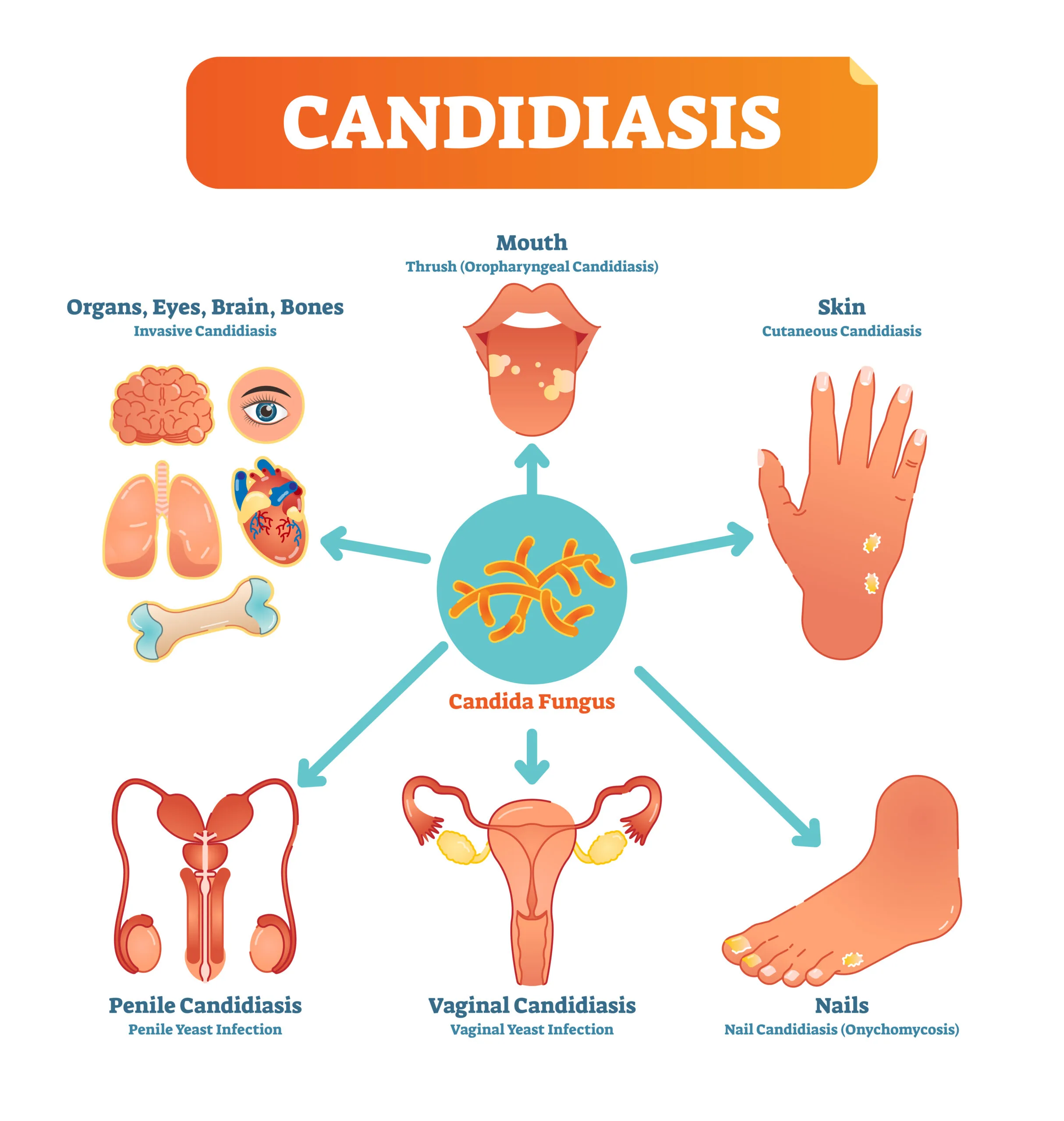 Candida/Yeast Overgrowth 4 Candidiasis medical vector illustration