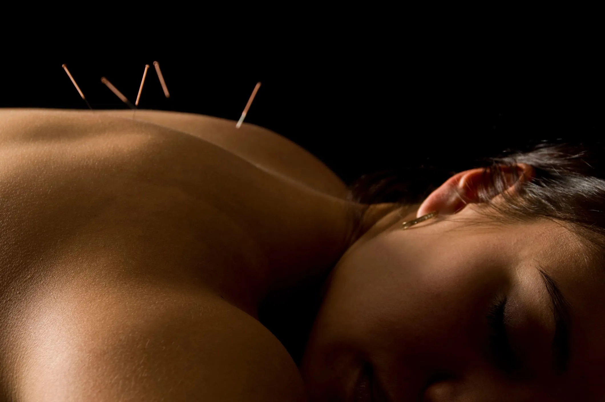 accupuncture 01