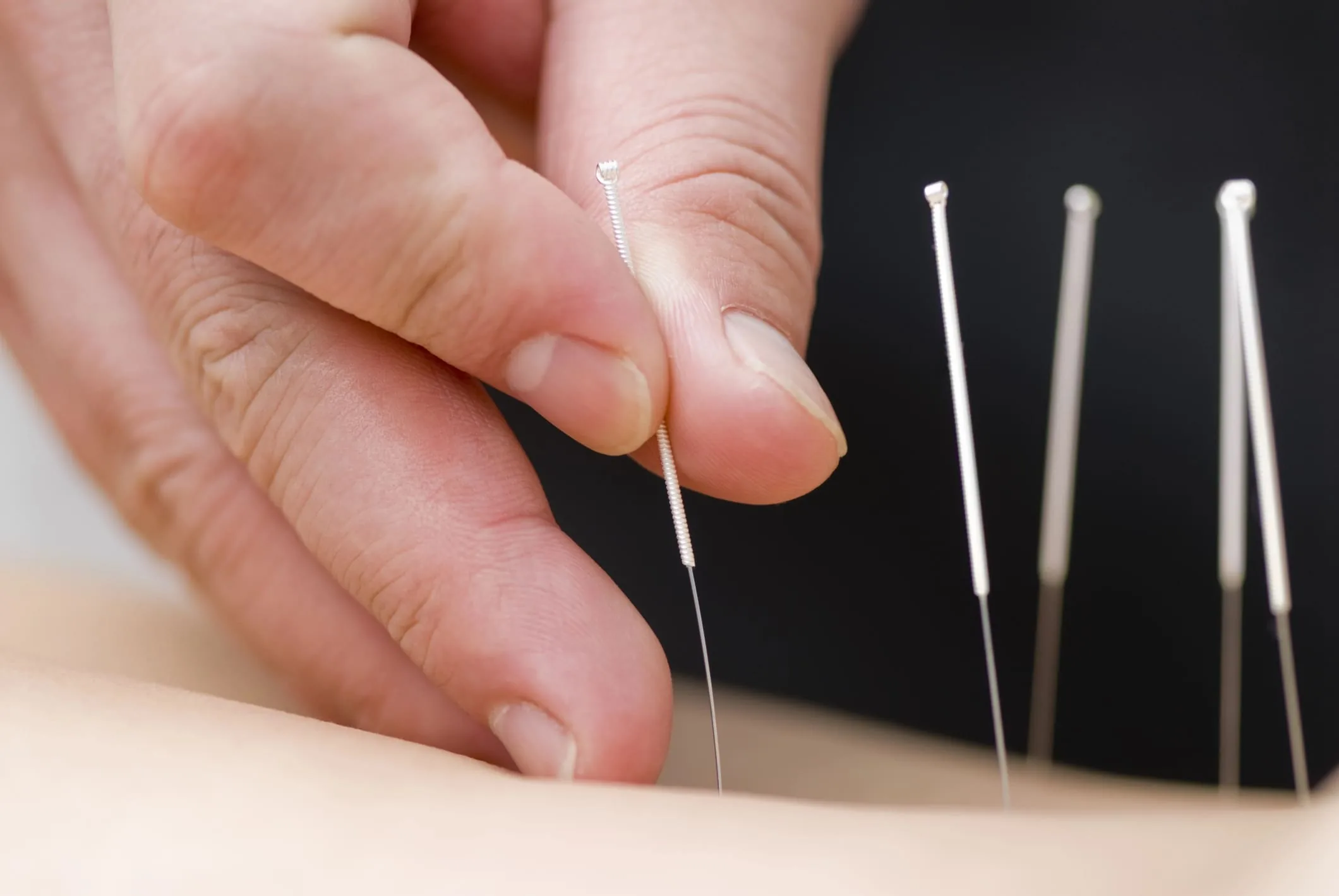 accupuncture 02
