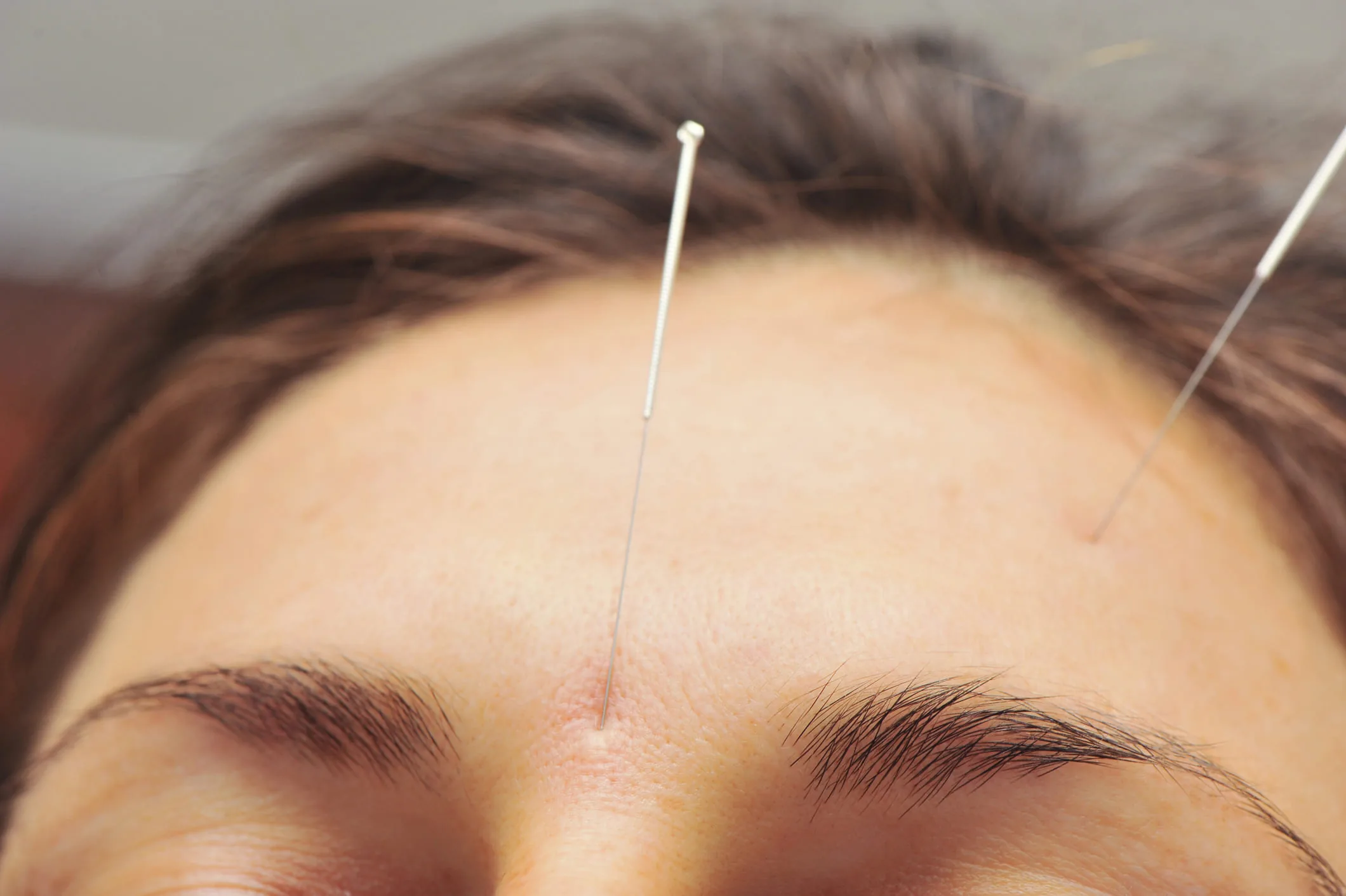 accupuncture 04